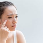 Woman worried about her acne